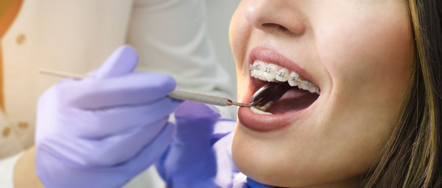 Zakończenie leczenia ortodontycznego - jak wygląda proces?
