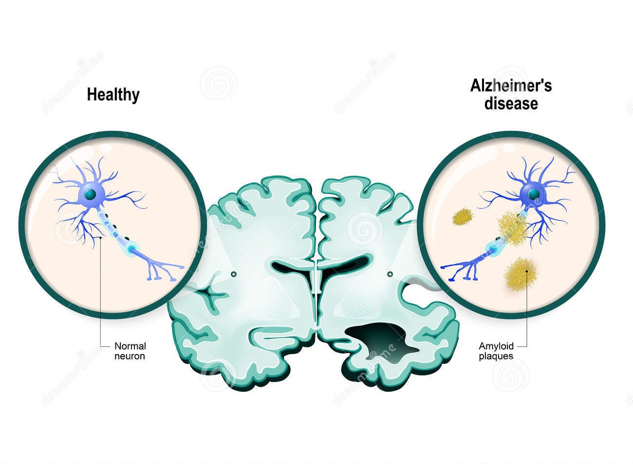 Lek na astmę w terapii choroby Alzheimera?